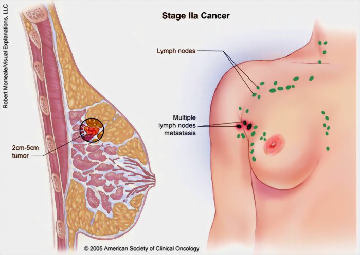 pengobatan kanker payudara